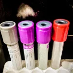 Laboratory test tubes arranged in a rack at a medical laboratory