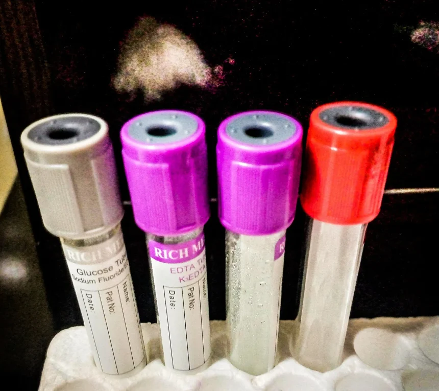 Laboratory test tubes arranged in a rack at a medical laboratory